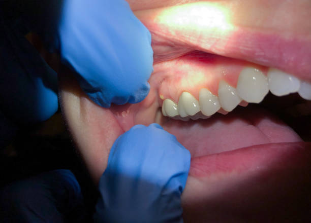 Best Emergency Dental Care for Abscessed Tooth in Stratford, NJ
